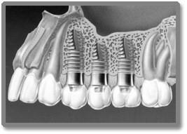 implants cancun 8ddc5