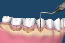 pockets around teeth 01b23