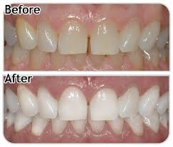 dental bleaching a11ea