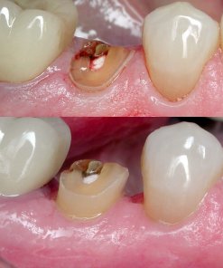 Crown Lengthening restorative 547ef