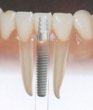 cancun dental implants 2 5b12b