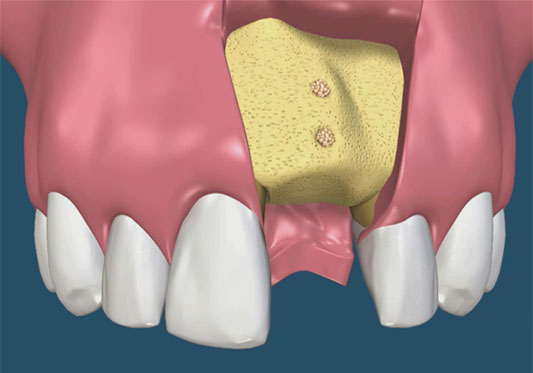 guided bone reg 03 big 42fe1