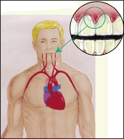 gum disease heart disease 4d2f3