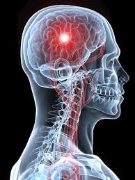 stroke gum disease f8939